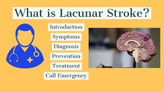 How to treat lacunar Stroke [upl. by Cataldo]