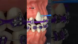 “Instalación de botón de ortodoncia para bajar colmillo” [upl. by Ylenaj]