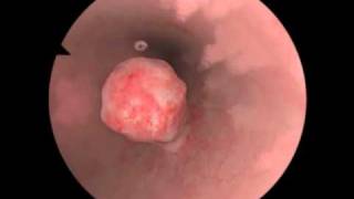 Polypectomy  Polyp Removal  New Features for Virtual Reality Surgical Simulation [upl. by Ophelie757]