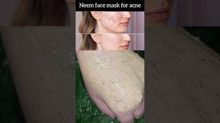 Diy Neem face mask for acne shorts skincare acne [upl. by Drummond]