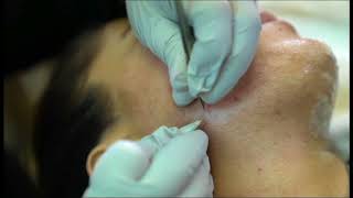 Electrolysis Permanent Hair Removal [upl. by Selda]