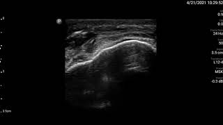 Knee Ultrasound Prepatellar Bursa Injection Part 1 [upl. by New]