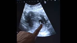 septate uterus with pregnancy and iucd displaced into right adnexa [upl. by Siravat]