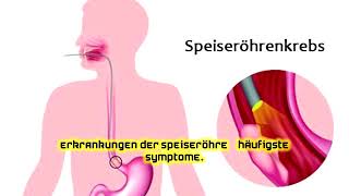 Erkrankungen der Speiseröhre – häufigste Symptome [upl. by Aihsikal]