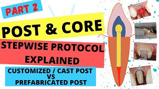 POST AND CORE Part2  SIMPLE STEPS FOR POST amp CORE PROCEDURE  Customized VS Prefabricated Post [upl. by Einnig642]