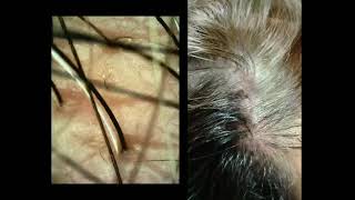 SKIN TALKSCALP GETTING FUNGAL INFECTion TINEA CAPITISRINGWORM OF THE SCALP [upl. by Ecnerolf]