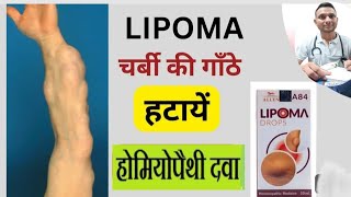 Homeopathic treatment for Lipoma  Lipoma  चर्बी की गांठ  Gath  Gilti गांठों का इलाज बिना ऑपरेशन [upl. by Tterab562]