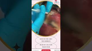 Face PRP with Vampire Facial  Antiaging Patient Treatment Process  Live View  Best Hair and Skin [upl. by Sair]