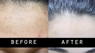 GET RID OF SMALL PIMPLES AND LIGHTEN SKIN NATURALLY FAST [upl. by Ecinerev300]