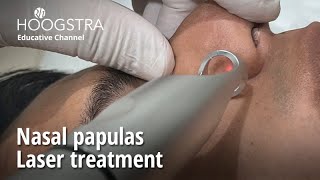 Nasal papulas  Laser treatment  23040 [upl. by Persse]