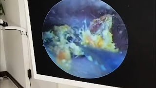 Hard cerumen embolism and dry slice cleaning earwax Cleaning earwaxremoval satisfying [upl. by Mitchel411]