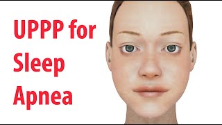 Uvulopalatopharyngoplasty UPPP for Sleep Apnea in Adults [upl. by Hunt]