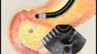 Endoscopic Ultrasound with Fine Needle Aspiration Biopsymp4 [upl. by Malva38]