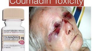 Coumadin  Warfarin toxicity [upl. by Niletak]