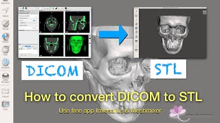 How to convert DICOM file to 3D printable STL file [upl. by Zwiebel]