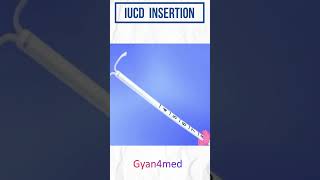 IUD insertion procedure in Hindi [upl. by Heer442]