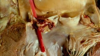 Infective Endocarditis  Pathology mini tutorial [upl. by Itirp]