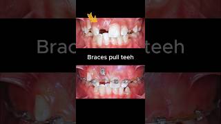 Braces for impacted tooth braces orthodontist dentist dentisty [upl. by Jarin]