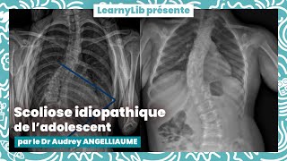 🩺 Pédiatrie  la scoliose idiopathique de ladolescent avec le Dr Audrey ANGELLIAUME [upl. by Ellehcsar]