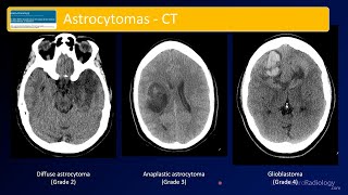 Emergency Imaging of Brain Tumors Astrocytomas [upl. by Tillion]