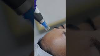 ✨ 𝐃𝐞𝐫𝐦𝐚𝐩𝐞𝐧 4  Revolutionary treatment for acnescars amp blemishes pimples dermapen4 trending [upl. by Anaiviv]