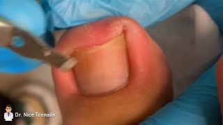 One toenail has a sharp nail and it was pulled out smoothly 💅  Dr Nice Toenails [upl. by Engapmahc393]