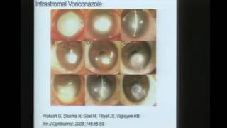 Innovations in Fungal Keratitis [upl. by Sharman]