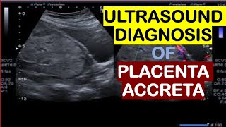 Ultrasound diagnosis of placenta accreta [upl. by Liagaba]