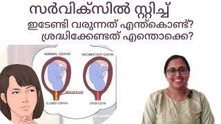 Short cervix during pregnancy malayalam cerclagecervix stitch malayalam drchithra pregnancytips [upl. by Spearing]