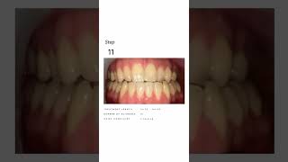 Clear Aligners in Action Watch a Smile Transform Before Your Eyes clearaligners [upl. by Melone187]