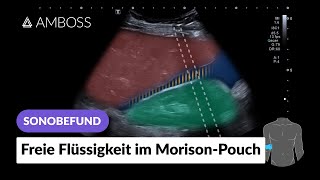 Sonobefund Freie Flüssigkeit im MorisonPouch  AMBOSS [upl. by Evey269]