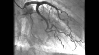 Kardiologie linkes Herzkranzgefäß  Darstellung der Kornararterien [upl. by Neumann]