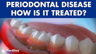 Periodontitis and its influence on health  How is periodontal disease treated © [upl. by Brittain5]