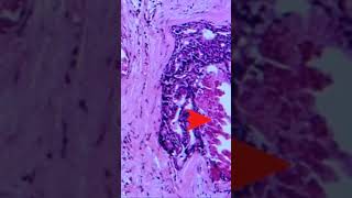 Ductal Carcinoma in Situ of Breast  Pathology shorts [upl. by Essiralc122]