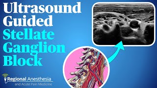 Ultrasound guided stellate ganglion block [upl. by Lonee]