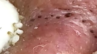 Blackheads amp Whiteheads Satisfying Removal 0115 [upl. by Cory]