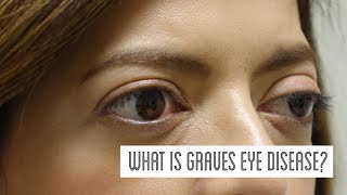 What is Graves Eye Disease [upl. by Ladew]