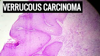 Verrucous Carcinoma Histopathology [upl. by Phemia663]