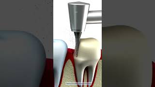 Dental Scaling amp Root Planing  prosper dentalscaling dentist deepcleaning [upl. by Abraham]