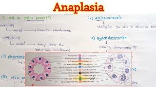 Anaplasia  Neoplasia  General Pathology [upl. by Enyar]