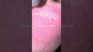 How to remove scars PERMANENTLY skincare beauty skincaretips [upl. by Carbo741]