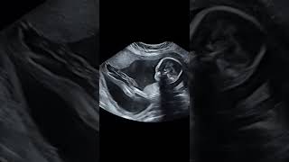 Ultrasonography in fetal movement [upl. by Gaile]