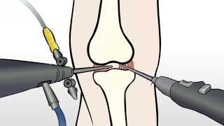 Regenexx Alternative to Knee Meniscus Surgery  Meniscectomy [upl. by Levison]