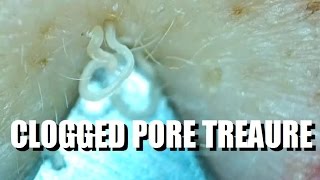 Clogged Pore Hidden Treasure Zit [upl. by Ruhnke799]