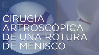 ¿Cómo se opera un menisco  Meniscectomía Cirugía artroscópica [upl. by Base]