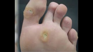 Foot Psoriasis Pain  The Home Treatment Guide [upl. by Anerrol156]