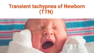 Transient Tachypnea of the Newborn [upl. by Nanam569]