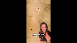 What is Cherry Angiomas [upl. by Landy664]