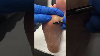 Expert Callus Removal by Australian Podiatrist using Ergonx and Docpods for PainFree Feet [upl. by Notsirb605]