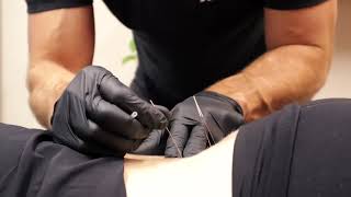 Dry Needling the low back [upl. by Head]